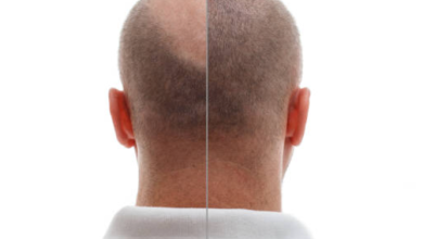 زراعة الشعر في الرياض