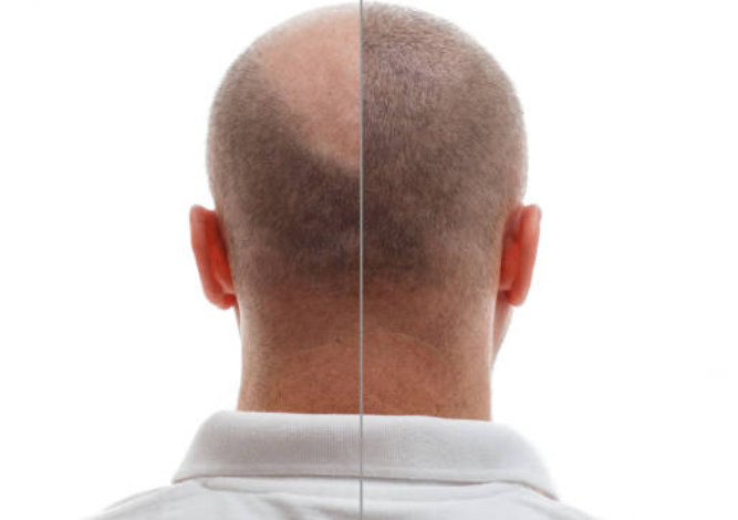 زراعة الشعر في الرياض
